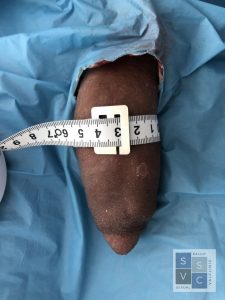 IMG 1356 768x1024 1 225x300 Penis enlargement