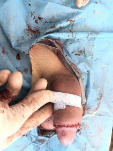 IMG 6273 e1592695878143 768x1024 1 225x300 Penis enlargement