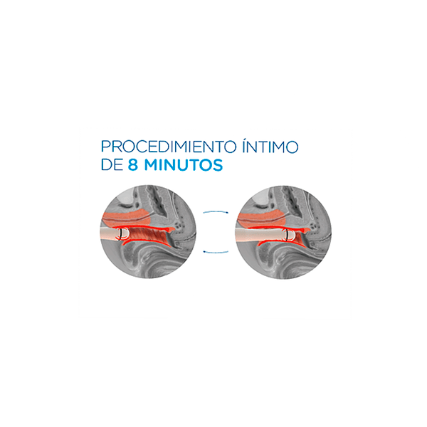 incontingencia urinaria Urinary incontinence without surgery