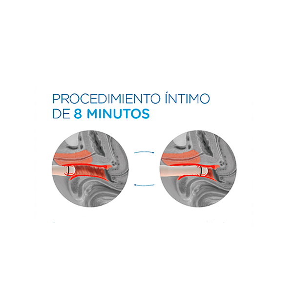 rejuvenecimiento vaginal 1 Vaginal rejuvenation