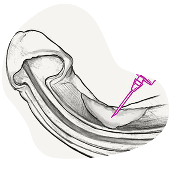 xiapex peyronie espana Curved penis