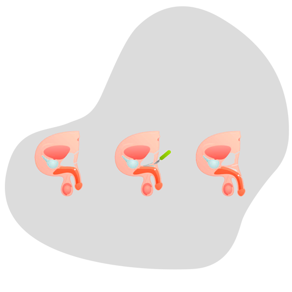 aumento2 Penis enlargement