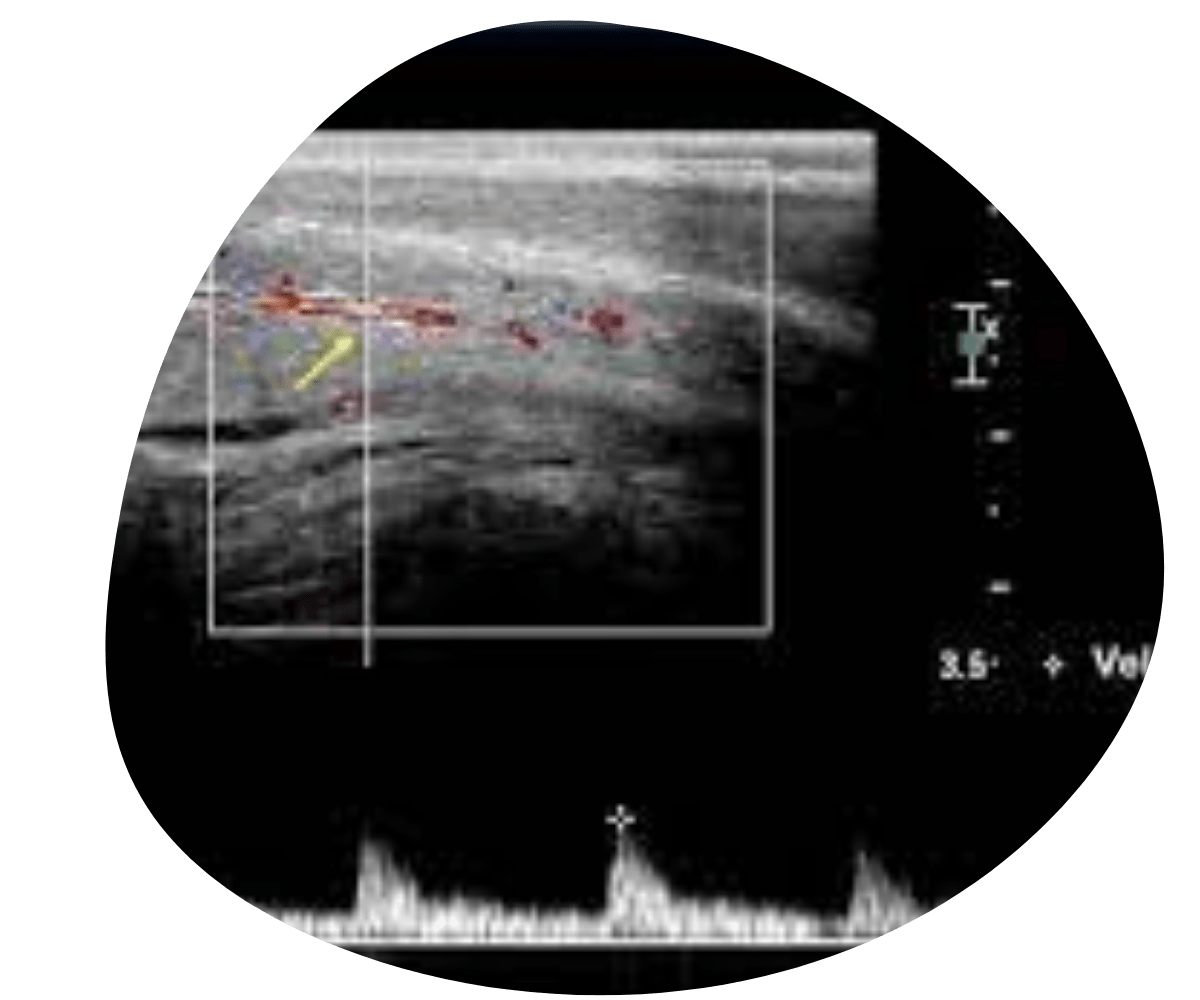 psicotek pantalla 26 Erectile dysfunction