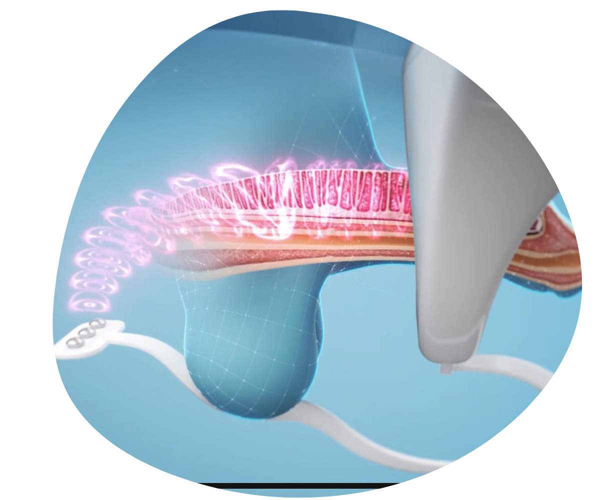 37 Disfunción eréctil