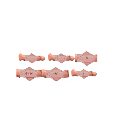 cirujia ppn9mdradvvjrgz3u274rabk03plrskwn2h7ri1sbk Curved penis