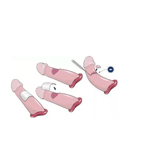 curvatura 1 ppo4tcjyj9wndumdkt37pdrpkkii3ux0njmp9myufc Curved penis