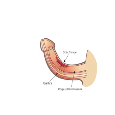 curvatura ppo50akztcn20ppqxyz9jnnyxkiplh92zm2isspuow Curved penis